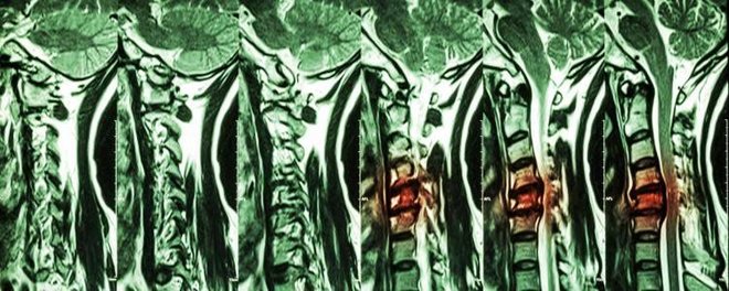 Krankengymnastik bei Spondylolyse MRT einer Spondylolyse