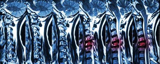 Spondylolisthesis in der HWS Das Wirbelgleiten (Spondylolosthesis) kann in allen Abschnitten der Wirbelsäule erfolgen