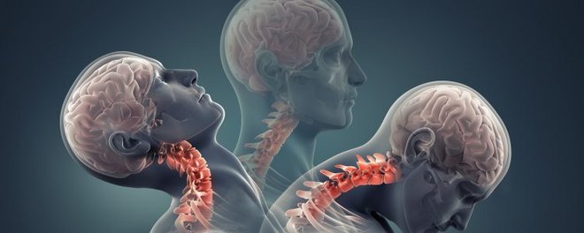 Physiotherapie bei einem Schleudertrauma
