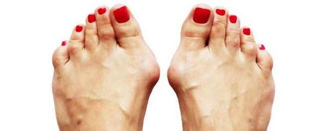 beim Hallux Valgus zieht der Mittelfußknochen vom Großzeh zur Seite