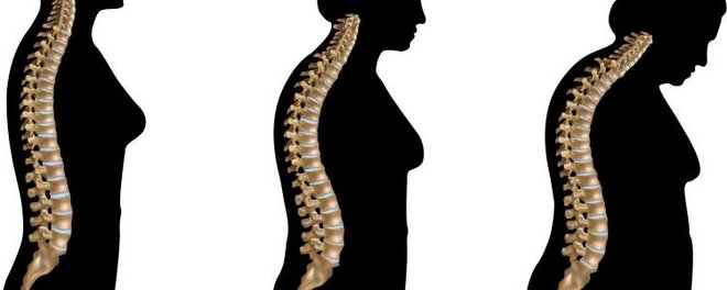 Mit zunehmender Osteoporose krümmt sich die Wirbelsäule