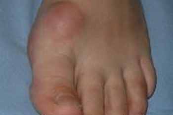 Hallux rigidus