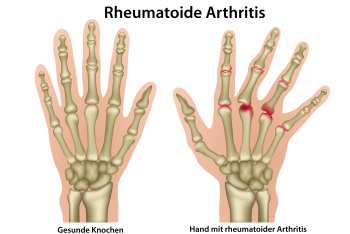 Polyarthritis in den Fingergelenken