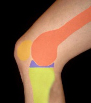 Bursitis am Knie