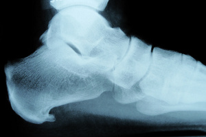 Fersensporn im Röntgenbilf